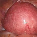 Uterine fibroids - ano ito?