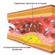 Холестерин (холестерол) — что это такое?