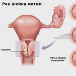 Kanser sa cervix: unang palatandaan, sintomas sa iba't ibang yugto at paggamot