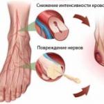 Ոտնաթաթի պարեզի պատճառները, ախտանիշները, բուժման և վերականգնման մեթոդները