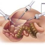 A posztoperatív tubális laparoszkópia