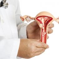 Uterine fibroids: sanhi, paggamot, komplikasyon Panlabas na mga palatandaan ng uterine fibroids
